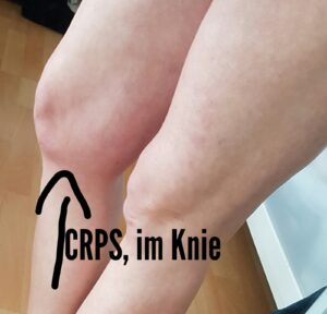 CRPS im Knie